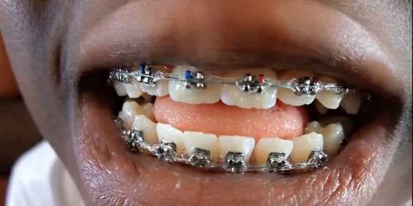 braces close up